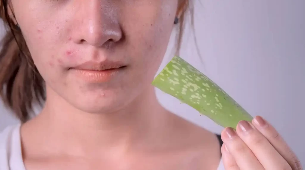 آلوئه ورا برای جوش
